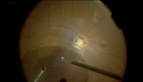 Optic Nerve Pit Maculopathy thumbnail
