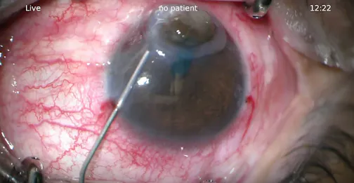 Repair of Bilateral Corneal Perforation