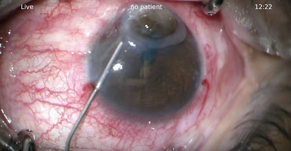 Repair of Bilateral Corneal Perforation thumbnail