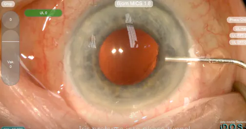 Battle With a Suprachoroidal Hemorrhage