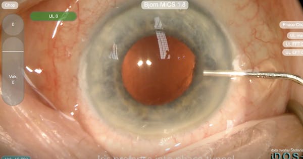 Battle With a Suprachoroidal Hemorrhage thumbnail
