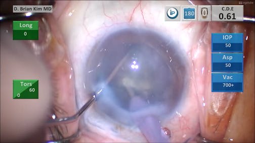 Mission Impossible? Phaco Through The Compromised Cornea
