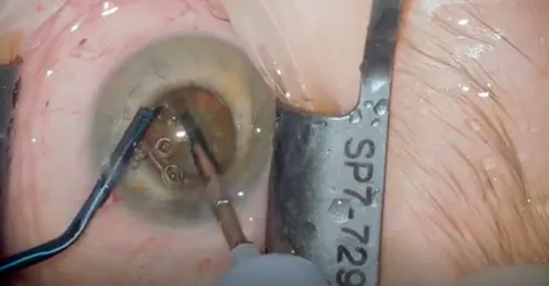 Bimanual Cataract Surgery With a Small Pupil