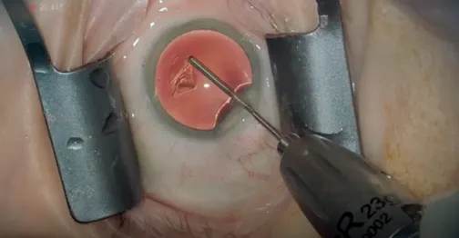 Standard Bimanual Cataract Surgery