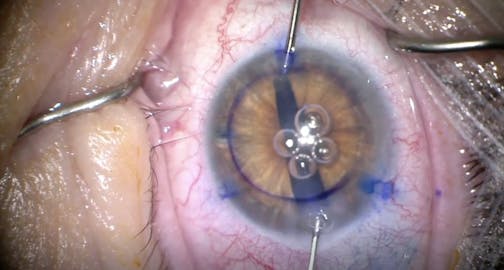 DMEK in a Post-Vitrectomized Eye