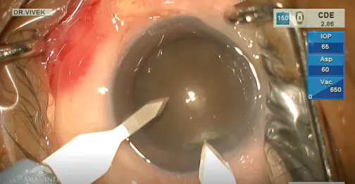Phacoemulsification in Brunescent Cataract