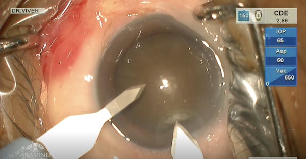 Phacoemulsification in Brunescent Cataract thumbnail
