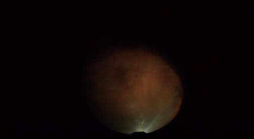 Chandelier-Assisted Scleral Buckling