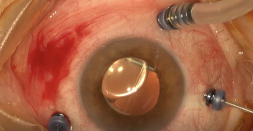 Management of a Subluxated Toric IOL