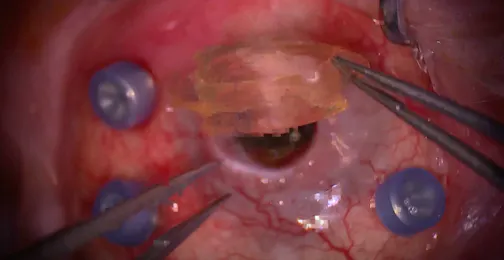 A Novel Temporary Keratoprosthesis Technique for Vitreoretinal Surgery