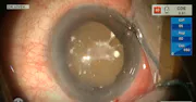 Absorbed Cataract: Phacoemulsification With a Piggyback IOL