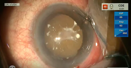 Absorbed Cataract: Phacoemulsification With a Piggyback IOL