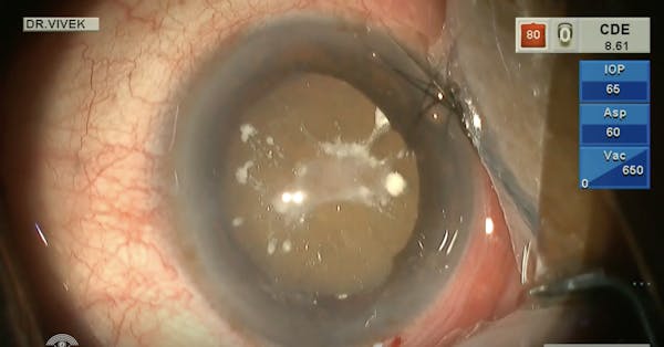 Absorbed Cataract: Phacoemulsification With a Piggyback IOL thumbnail