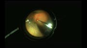 Blunt Trauma-Related Giant Retinal Tear With Dropped Lens