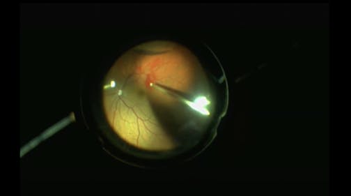 Blunt Trauma-Related Giant Retinal Tear With Dropped Lens