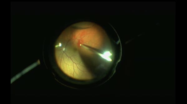 Blunt Trauma-Related Giant Retinal Tear With Dropped Lens thumbnail