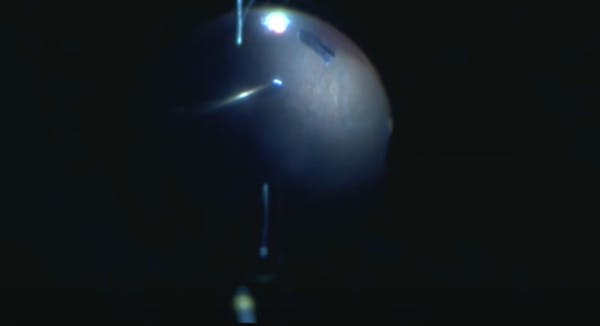 Combined Surgery for Intraocular Foreign Body Removal thumbnail