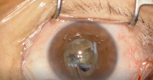 V-Shaped Phacoemulsification Technique: Preserving the Zonules