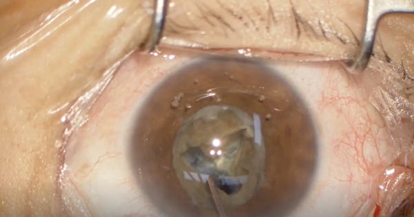 V-Shaped Phacoemulsification Technique: Preserving the Zonules thumbnail