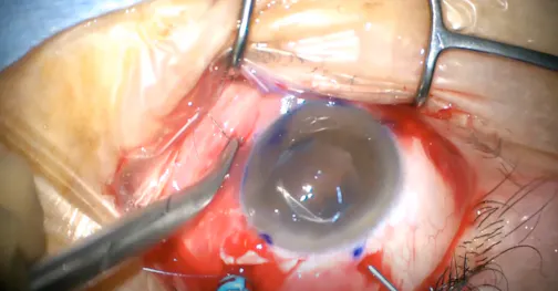 Pentagon Suturing Technique to Correct Lens Dislocation