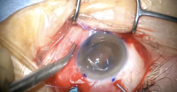 Pentagon Suturing Technique to Correct Lens Dislocation thumbnail