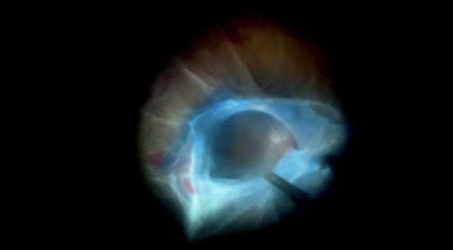 Retinal Detachment With Fibrovascular Membrane Peel and a Surprise Metal Foreign Body