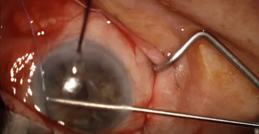 Semi-Open Sub-Tenon Ab Interno Xen Gel Stent