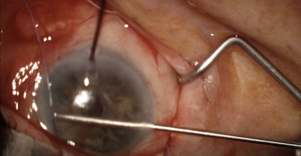 Semi-Open Sub-Tenon Ab Interno Xen Gel Stent thumbnail