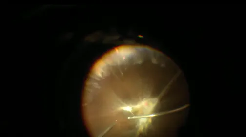 Advanced Traction Retinal Detachment Repair in a Patient With Proliferative Diabetic Retinopathy