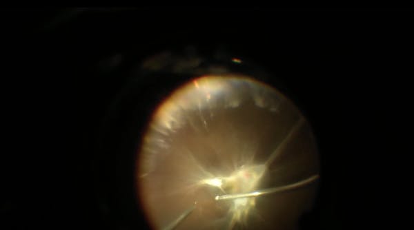 Advanced Traction Retinal Detachment Repair in a Patient With Proliferative Diabetic Retinopathy thumbnail