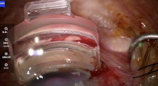 Hands-Free Gonio Use During Hydrus Implantation
