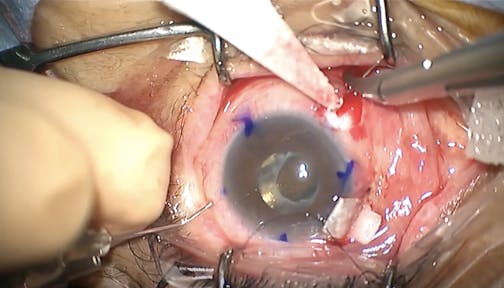Trabeculectomy and Dislocated IOL Correction Using the Pentagon Suturing Technique