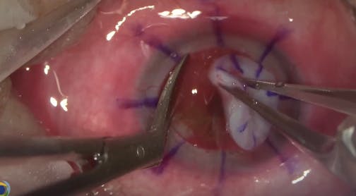 Sequential Surgery in a Perforated Cornea