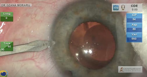 ICL Removal and Phacoemulsification With PCIOL Implantation