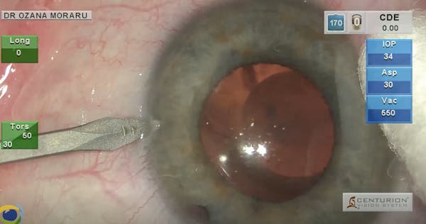ICL Removal and Phacoemulsification With PCIOL Implantation thumbnail