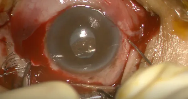 Correction of IOL Donesis Via the Parallel Suturing Technique thumbnail