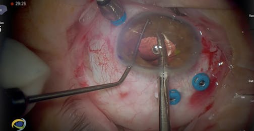 IOL Removal and Reimplantation