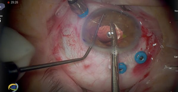 IOL Removal and Reimplantation thumbnail