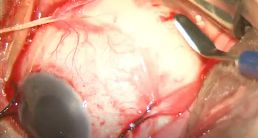 Modified Encircling Scleral Band Buckle Technique