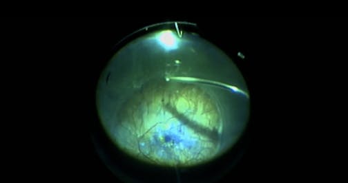Macular Hole—Related Retinal Detachment in High Myopia