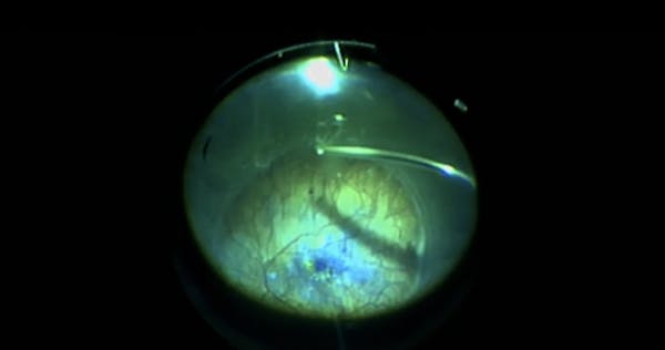 Macular Hole—Related Retinal Detachment in High Myopia thumbnail