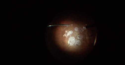 Myopic Maculoschisis