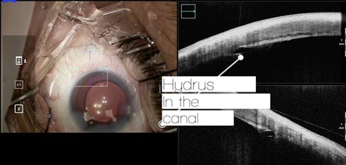 Using Intraoperative OCT to View the Canal During Hydrus Implantation