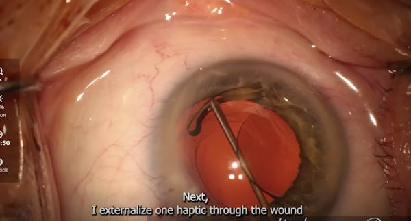 The Twist-and-Out Technique for IOL Exchange thumbnail