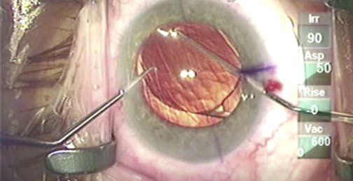 Forward Optic Capture of a Rotated Toric IOL