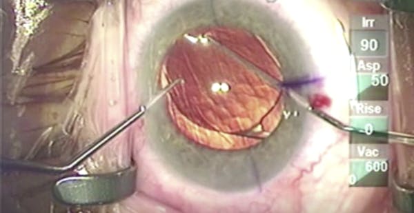 Forward Optic Capture of a Rotated Toric IOL thumbnail