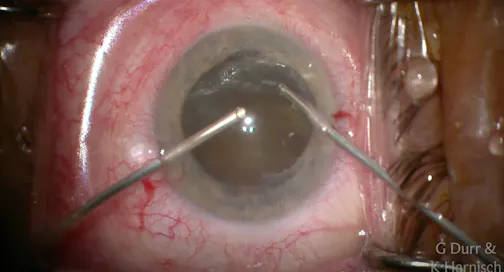 Surgical Repair of a Subluxated Cataract and Pupilloplasty