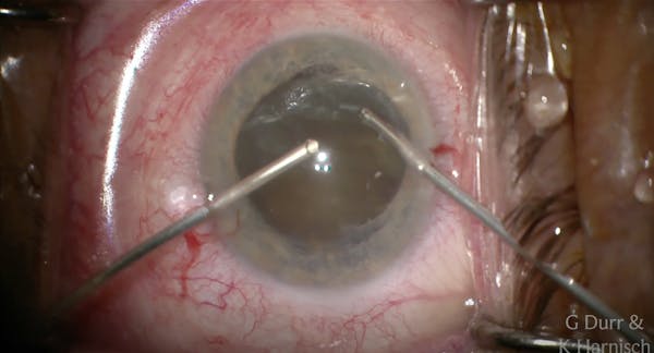 Surgical Repair of a Subluxated Cataract and Pupilloplasty thumbnail
