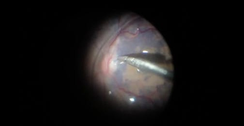 Stuff-In Technique With Brilliant Blue Dye and Perfluorocarbon Liquid for Large Macular Holes