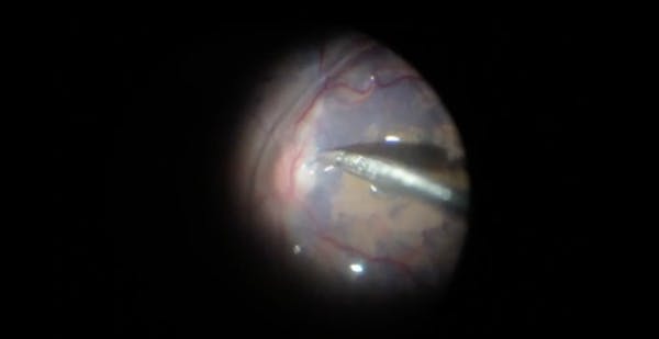 Stuff-In Technique With Brilliant Blue Dye and Perfluorocarbon Liquid for Large Macular Holes thumbnail
